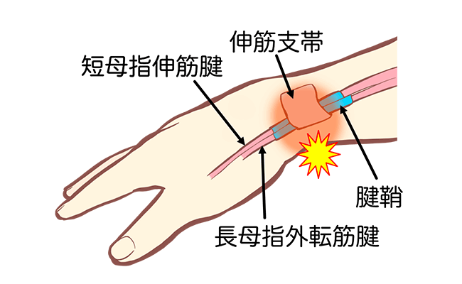 腱鞘炎