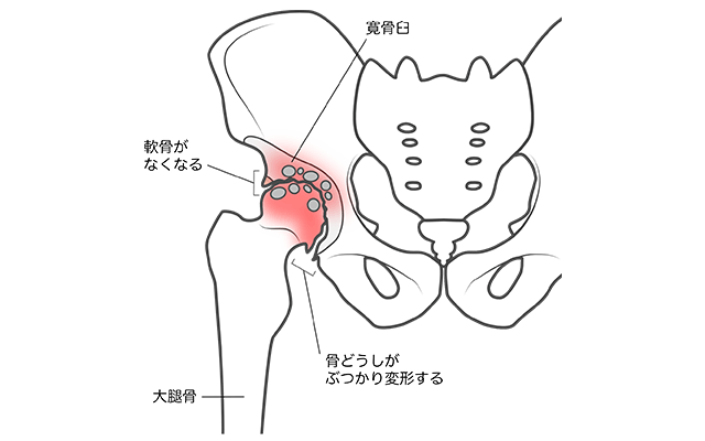 変形性股関節症のイラスト