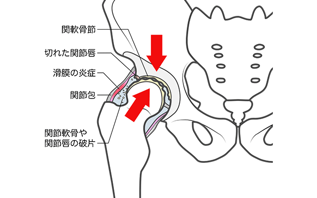 変形性股関節症のイラスト
